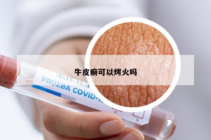 牛皮癣可以烤火吗