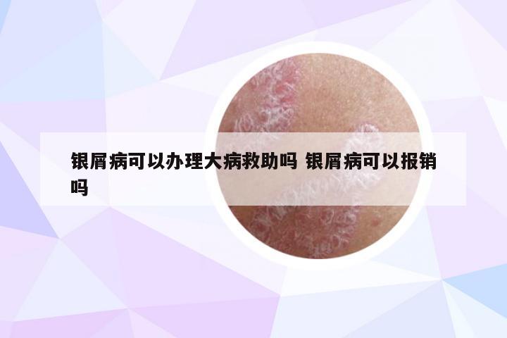 银屑病可以办理大病救助吗 银屑病可以报销吗