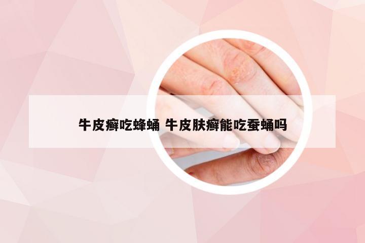 牛皮癣吃蜂蛹 牛皮肤癣能吃蚕蛹吗
