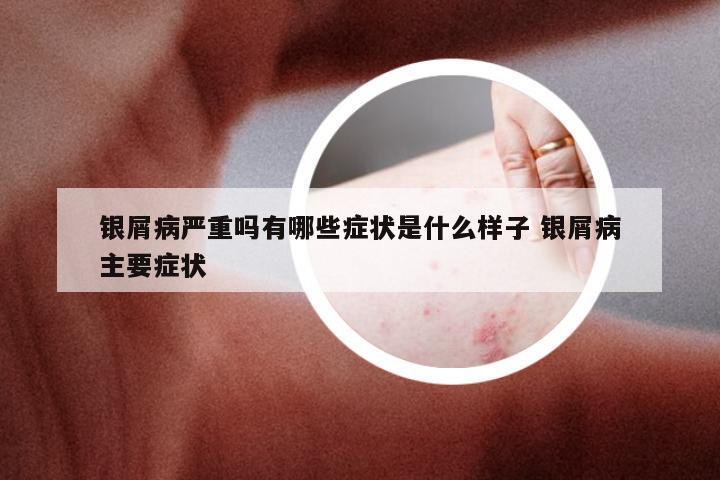 银屑病严重吗有哪些症状是什么样子 银屑病主要症状