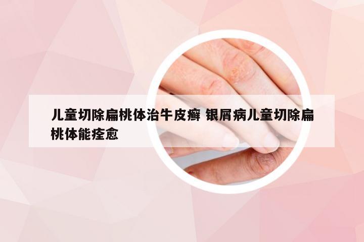 儿童切除扁桃体治牛皮癣 银屑病儿童切除扁桃体能痊愈