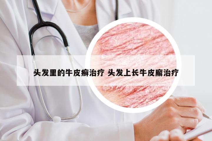 头发里的牛皮癣治疗 头发上长牛皮廨治疗