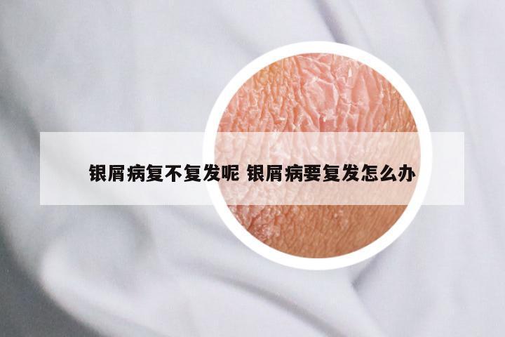 银屑病复不复发呢 银屑病要复发怎么办