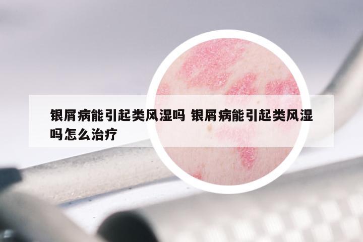 银屑病能引起类风湿吗 银屑病能引起类风湿吗怎么治疗