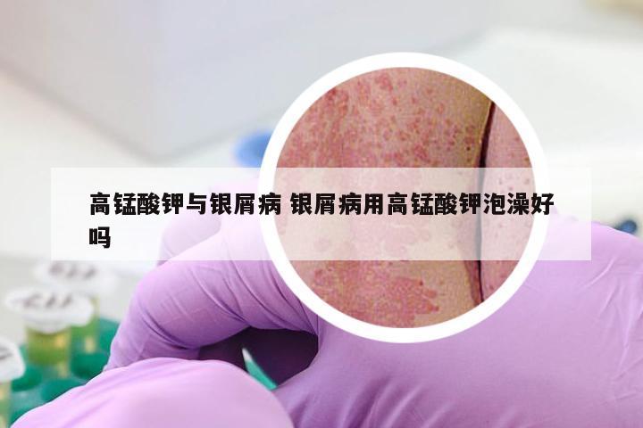 高锰酸钾与银屑病 银屑病用高锰酸钾泡澡好吗