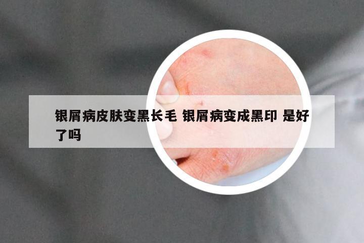 银屑病皮肤变黑长毛 银屑病变成黑印 是好了吗