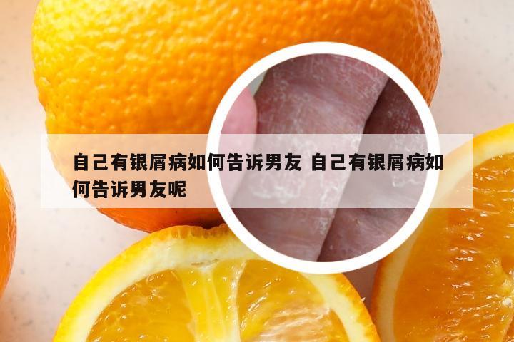 自己有银屑病如何告诉男友 自己有银屑病如何告诉男友呢