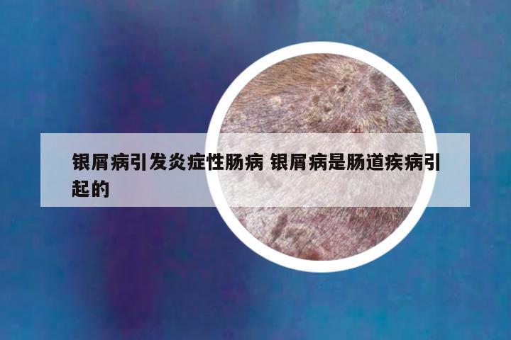银屑病引发炎症性肠病 银屑病是肠道疾病引起的