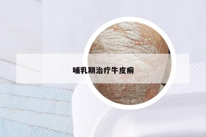 哺乳期治疗牛皮癣