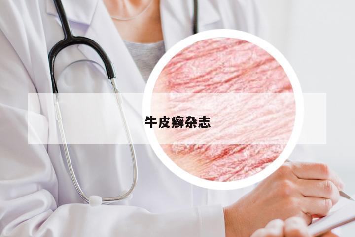 牛皮癣杂志