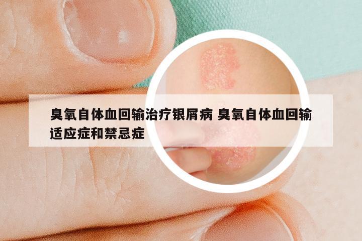 臭氧自体血回输治疗银屑病 臭氧自体血回输适应症和禁忌症