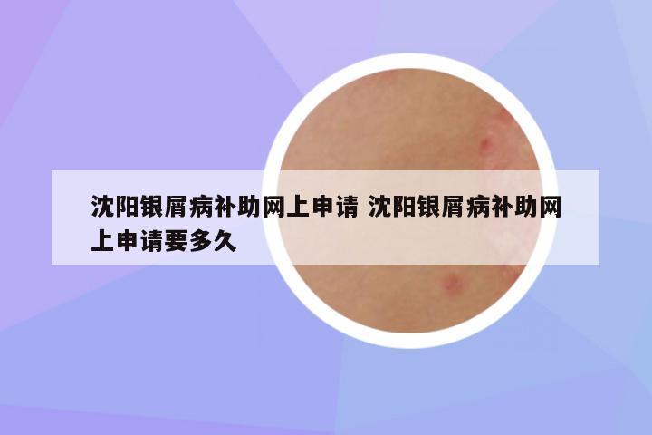 沈阳银屑病补助网上申请 沈阳银屑病补助网上申请要多久