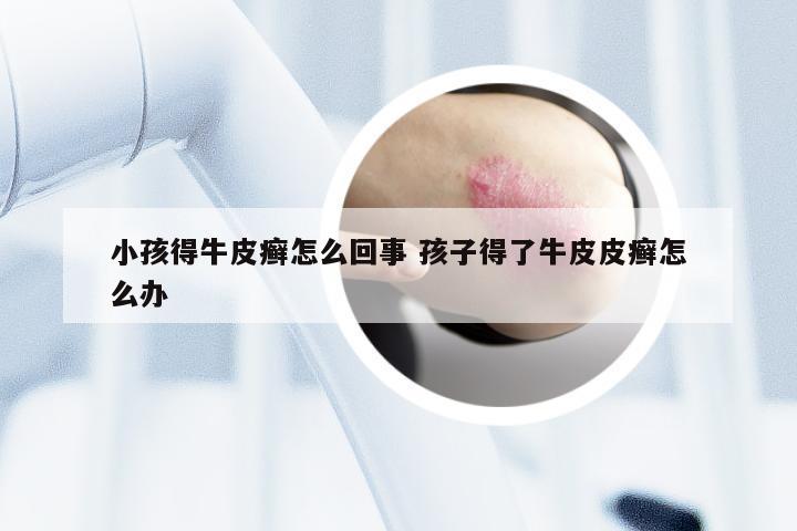 小孩得牛皮癣怎么回事 孩子得了牛皮皮癣怎么办