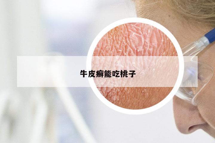 牛皮癣能吃桃子