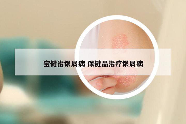 宝健治银屑病 保健品治疗银屑病