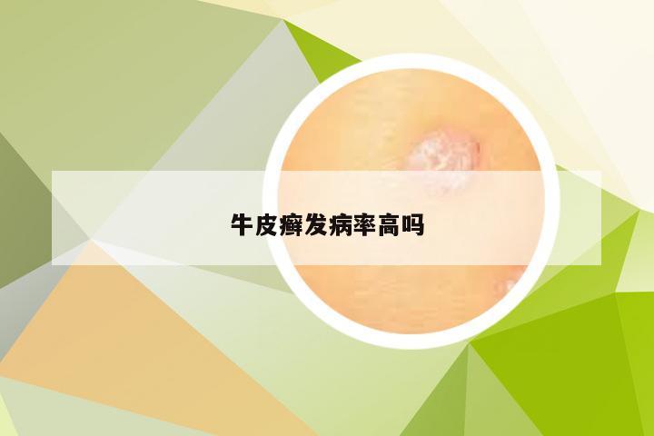 牛皮癣发病率高吗