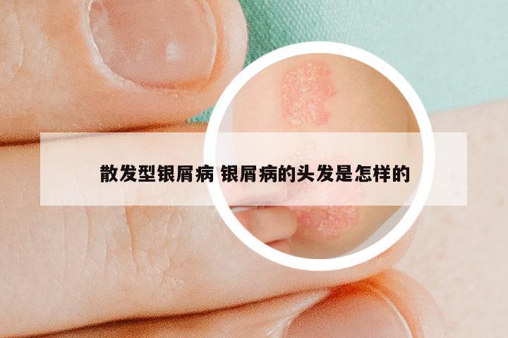 散发型银屑病 银屑病的头发是怎样的