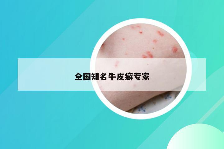 全国知名牛皮癣专家