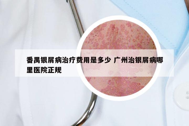番禺银屑病治疗费用是多少 广州治银屑病哪里医院正规