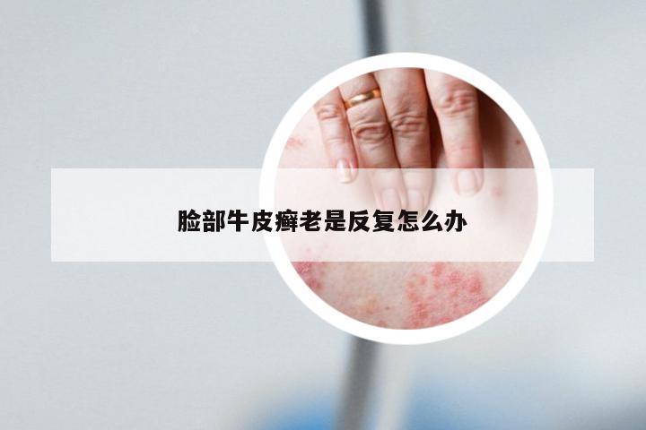 脸部牛皮癣老是反复怎么办