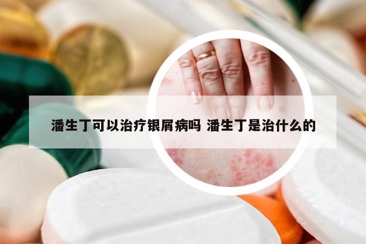 潘生丁可以治疗银屑病吗 潘生丁是治什么的