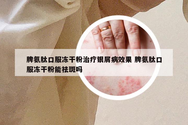 脾氨肽口服冻干粉治疗银屑病效果 脾氨肽口服冻干粉能祛斑吗