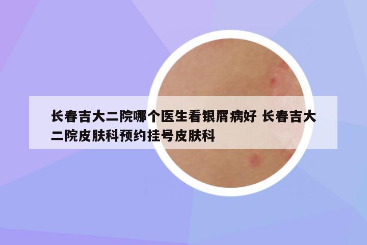 长春吉大二院哪个医生看银屑病好 长春吉大二院皮肤科预约挂号皮肤科