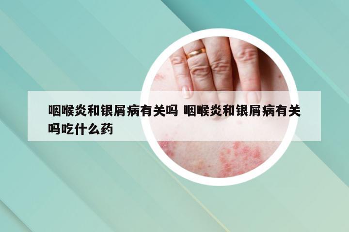 咽喉炎和银屑病有关吗 咽喉炎和银屑病有关吗吃什么药