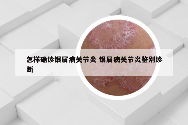 怎样确诊银屑病关节炎 银屑病关节炎鉴别诊断