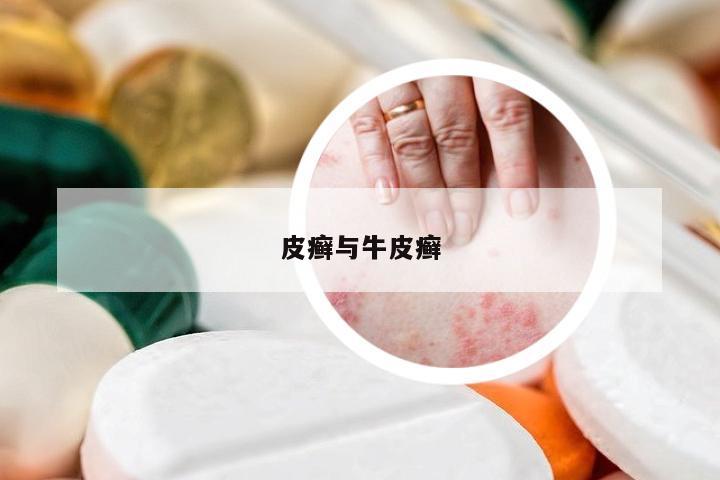 皮癣与牛皮癣