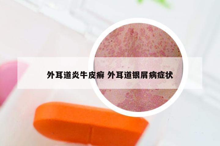 外耳道炎牛皮癣 外耳道银屑病症状