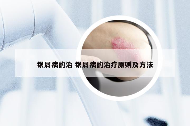 银屑病的治 银屑病的治疗原则及方法