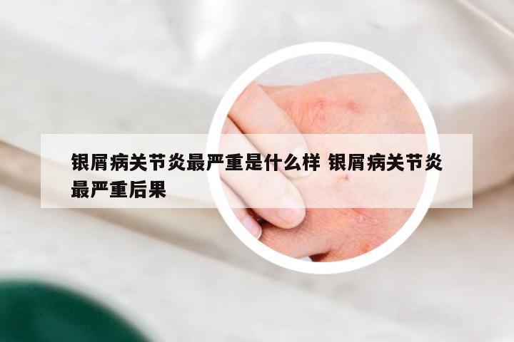 银屑病关节炎最严重是什么样 银屑病关节炎最严重后果