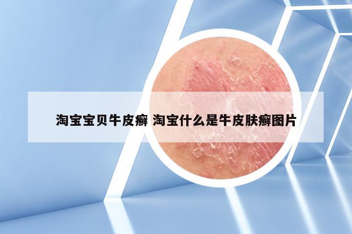 淘宝宝贝牛皮癣 淘宝什么是牛皮肤癣图片