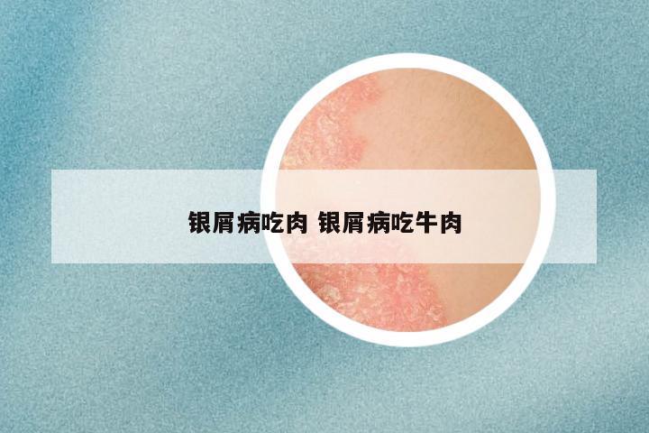 银屑病吃肉 银屑病吃牛肉