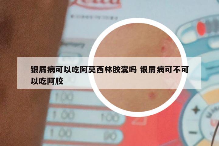 银屑病可以吃阿莫西林胶囊吗 银屑病可不可以吃阿胶