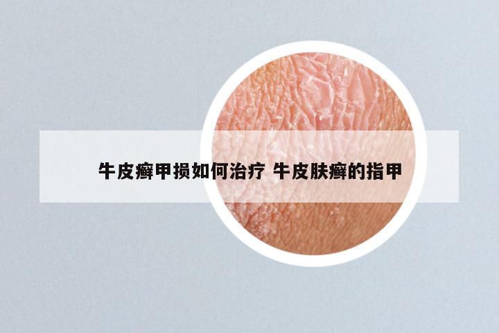 牛皮癣甲损如何治疗 牛皮肤癣的指甲