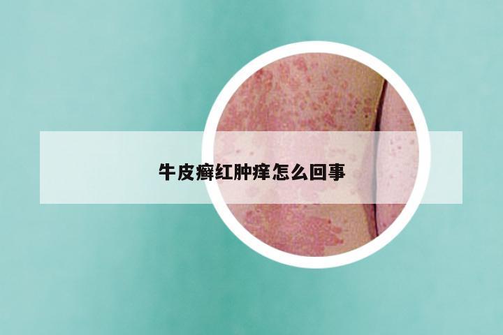 牛皮癣红肿痒怎么回事