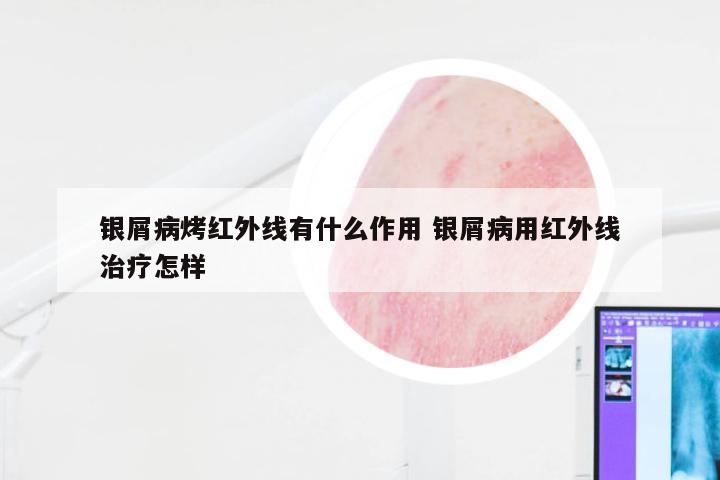 银屑病烤红外线有什么作用 银屑病用红外线治疗怎样