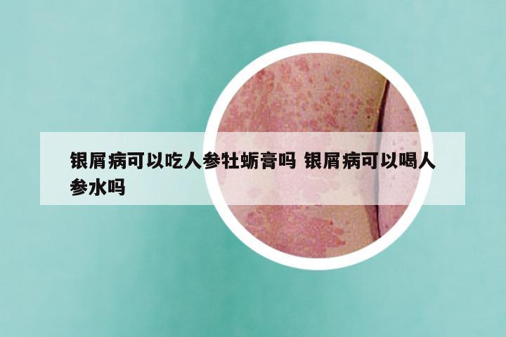 银屑病可以吃人参牡蛎膏吗 银屑病可以喝人参水吗