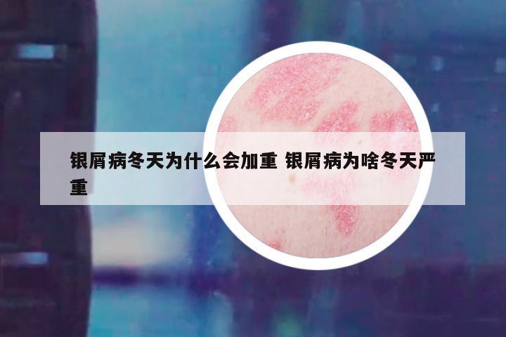 银屑病冬天为什么会加重 银屑病为啥冬天严重