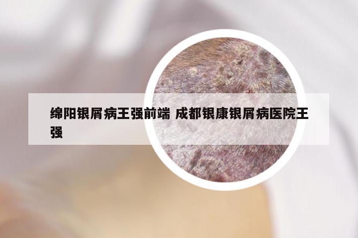 绵阳银屑病王强前端 成都银康银屑病医院王强