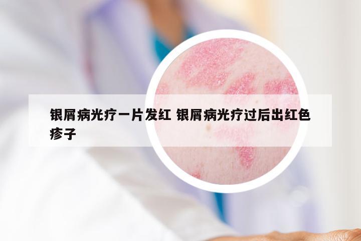 银屑病光疗一片发红 银屑病光疗过后出红色疹子