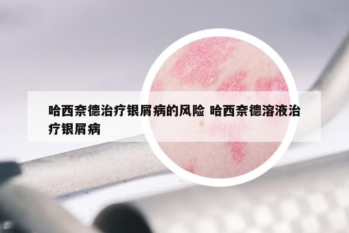 哈西奈德治疗银屑病的风险 哈西奈德溶液治疗银屑病