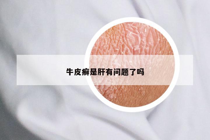 牛皮癣是肝有问题了吗
