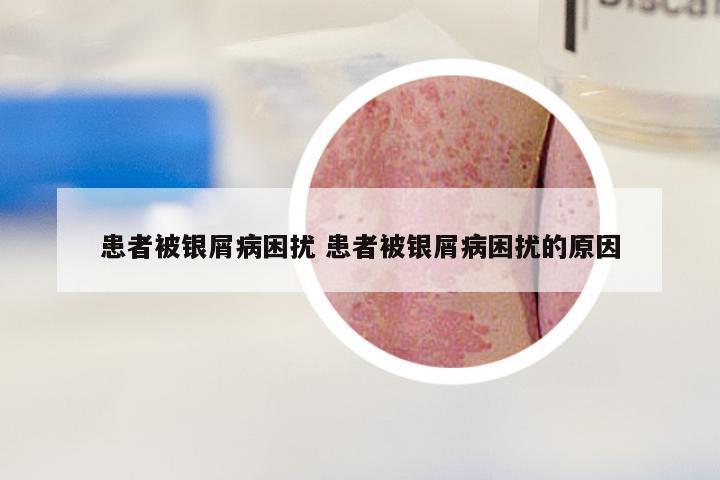 患者被银屑病困扰 患者被银屑病困扰的原因