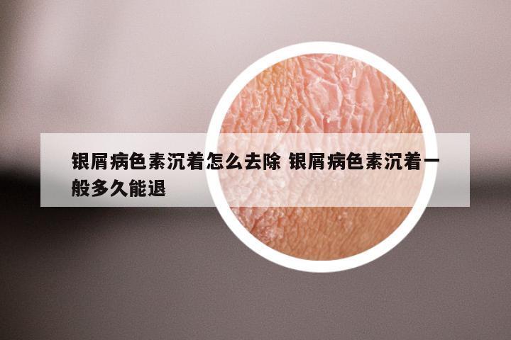 银屑病色素沉着怎么去除 银屑病色素沉着一般多久能退