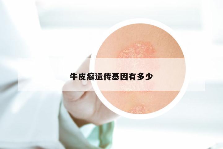 牛皮癣遗传基因有多少