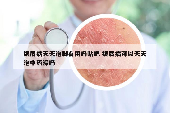 银屑病天天泡脚有用吗贴吧 银屑病可以天天泡中药澡吗