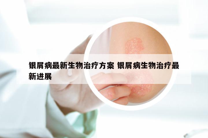 银屑病最新生物治疗方案 银屑病生物治疗最新进展
